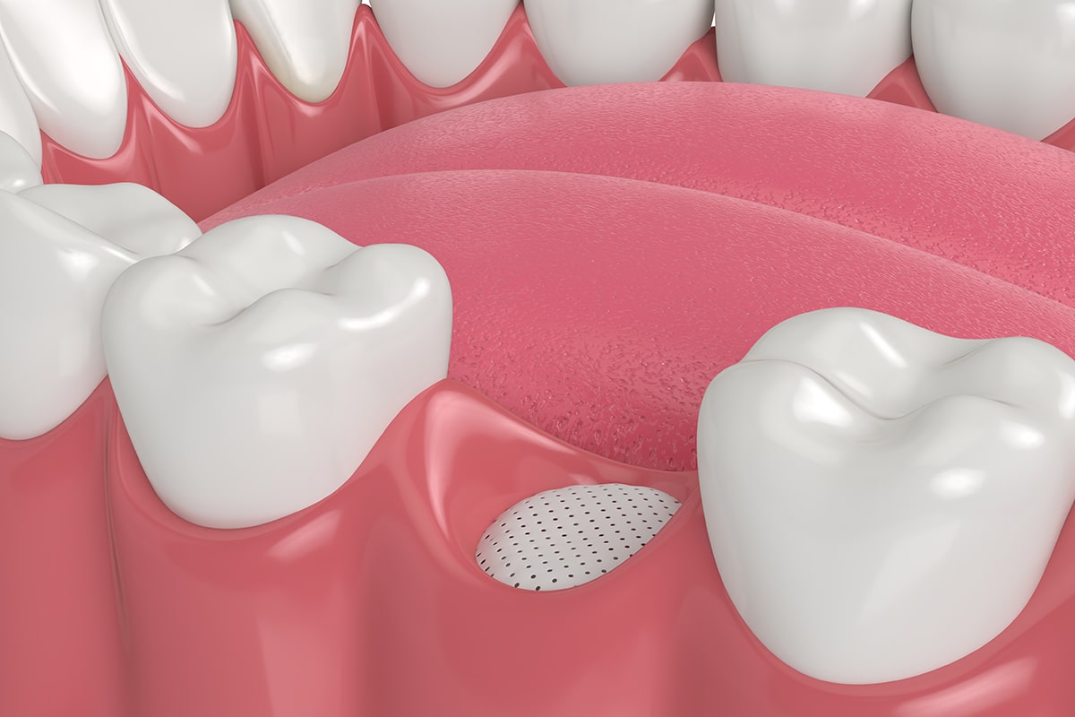 Bone grafting before dental implants why its important blog