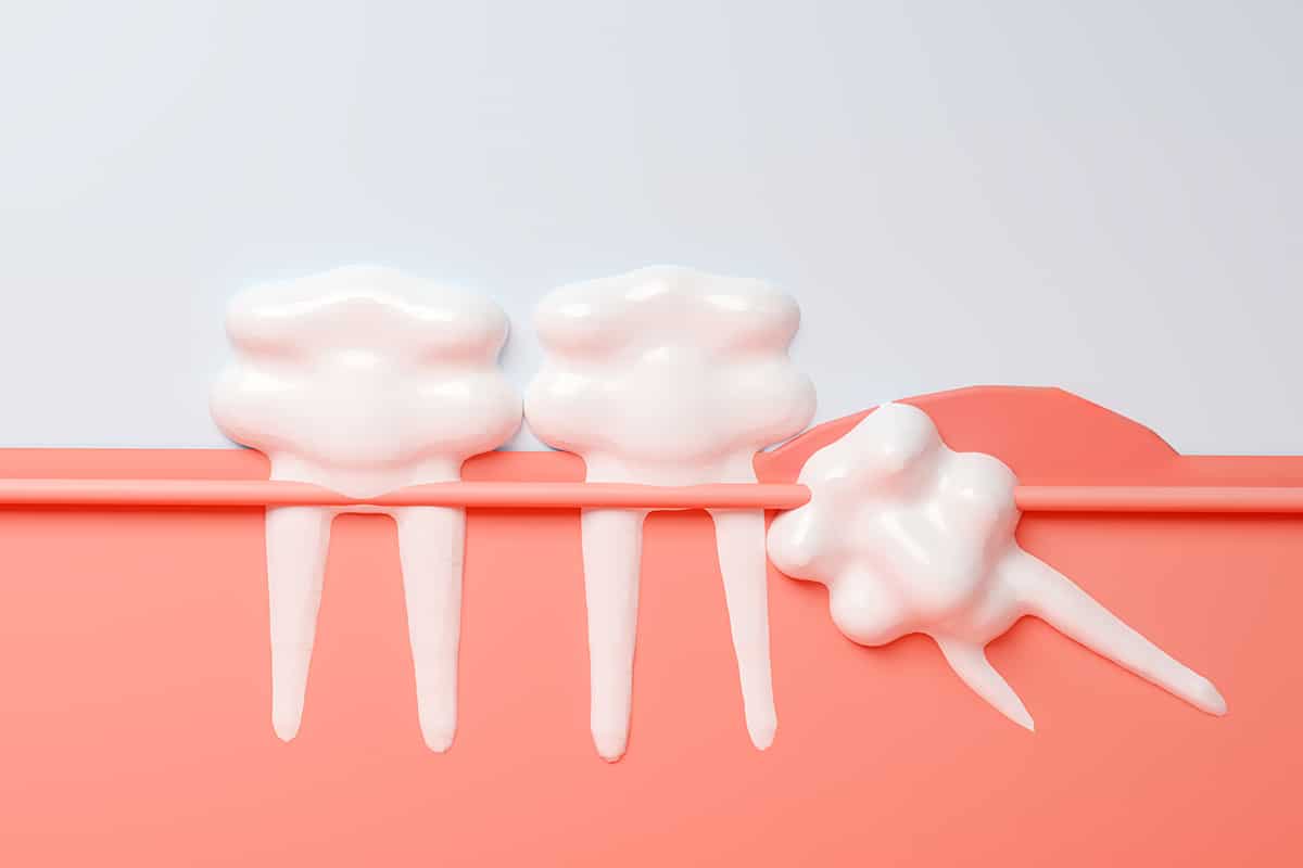 What is surgical exposure for impacted teeth blog